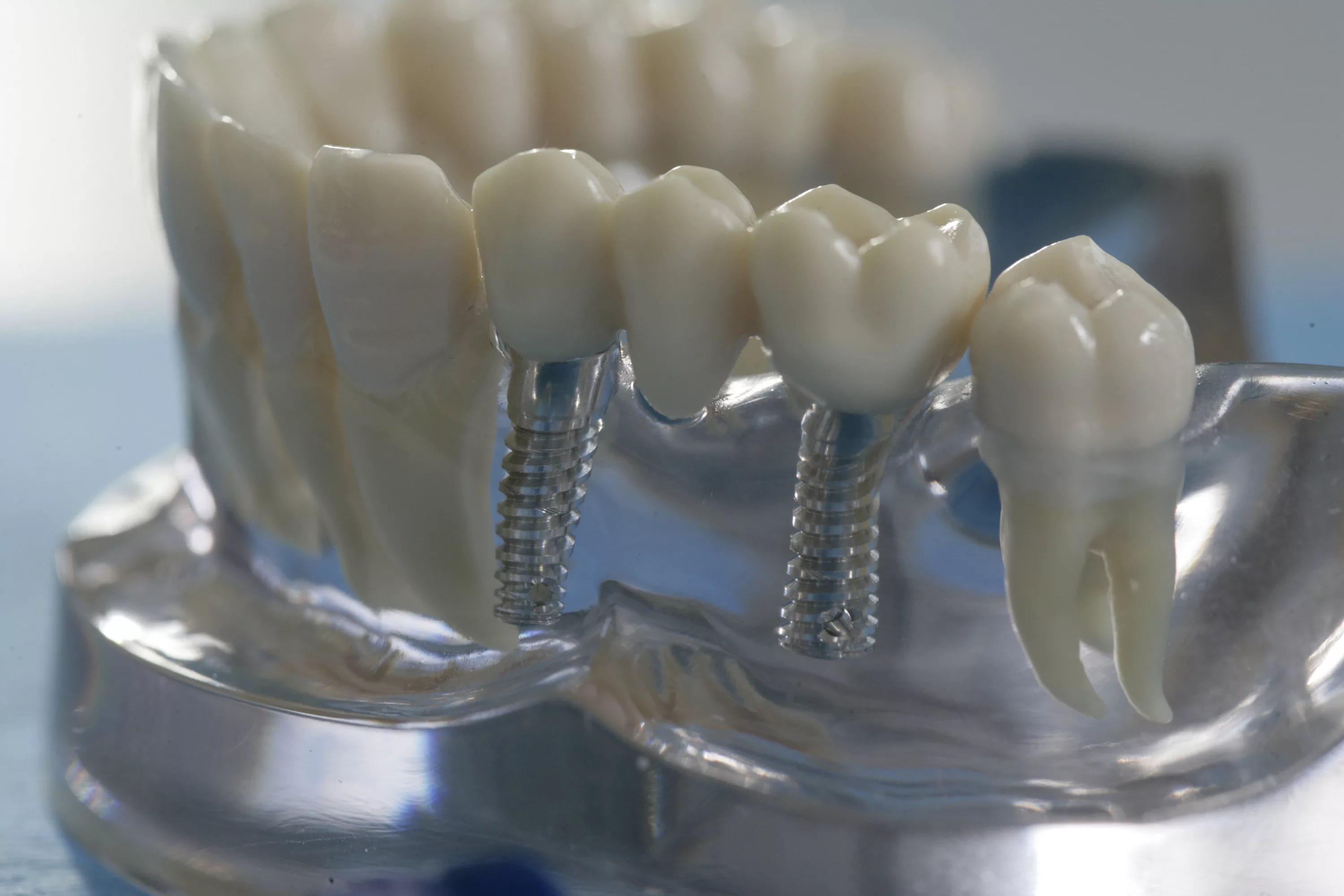 Зубы спб. Мостовидный протез на 1 зуб. Несъемные зубные протезы. Мостовидынй протез на имплант.